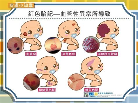 胎記位置意義手